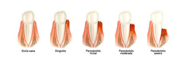 tratamiento periodontal guillena