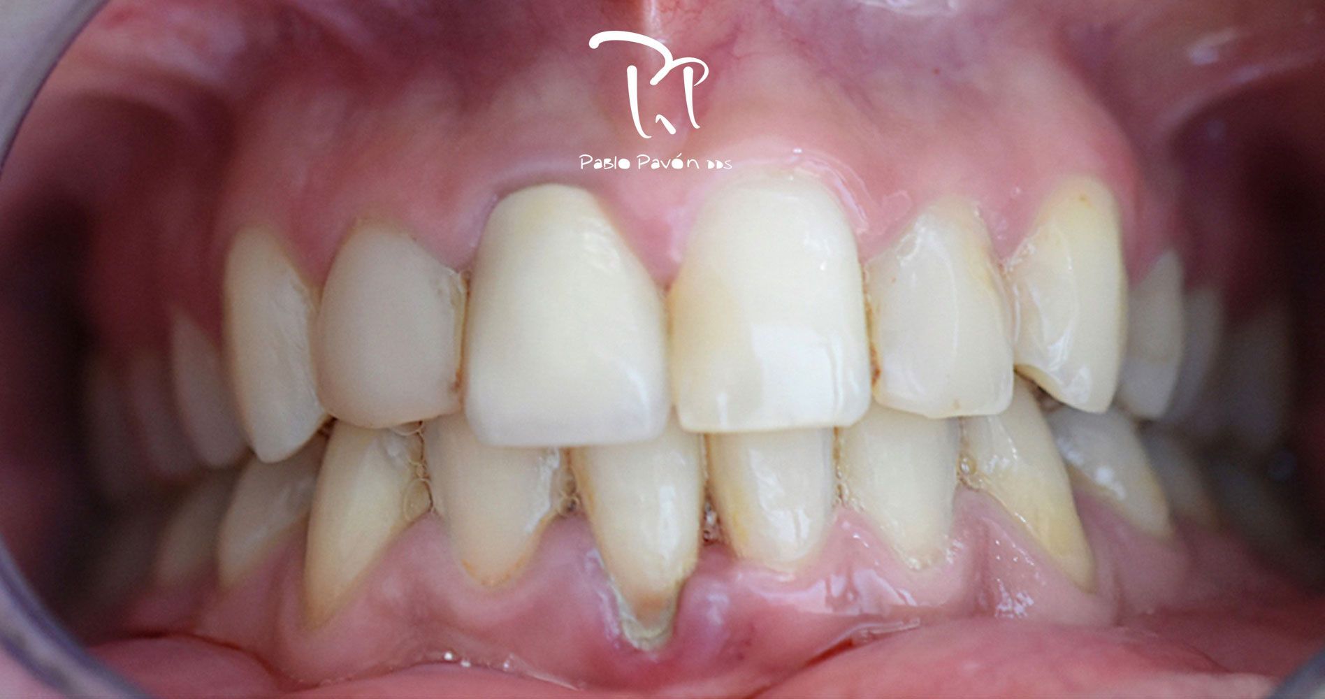 antes-tratamiento-periodontal-guillena