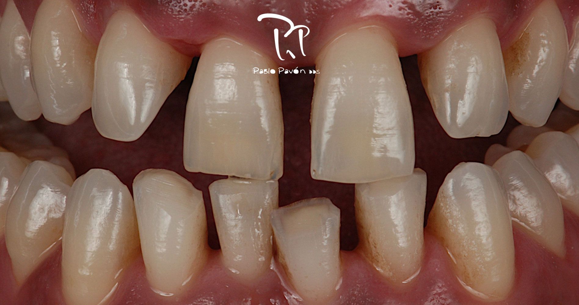 antes-implantes-dentales-y-tratamiento-periodontal-guillena