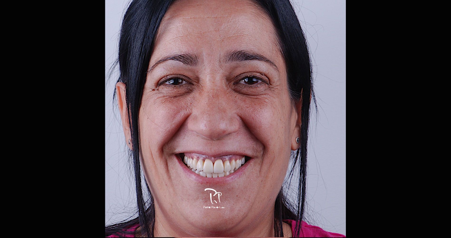 tratamiento implantes dentales guillena